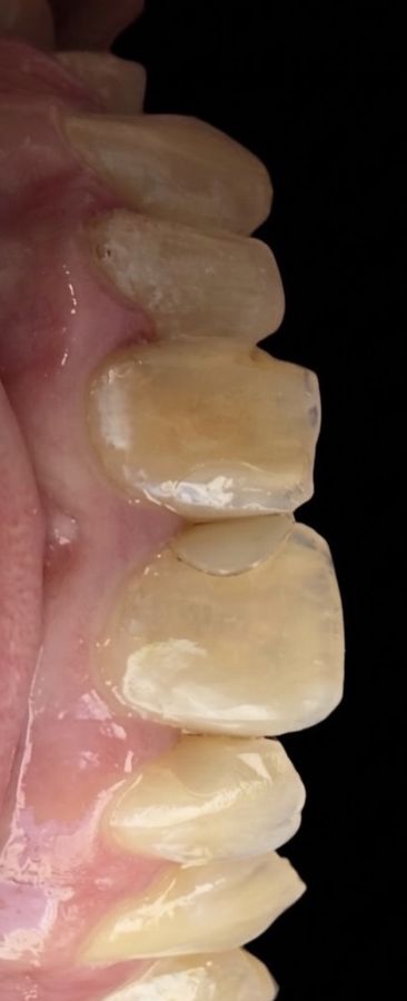 Dents antérieures avant traitement