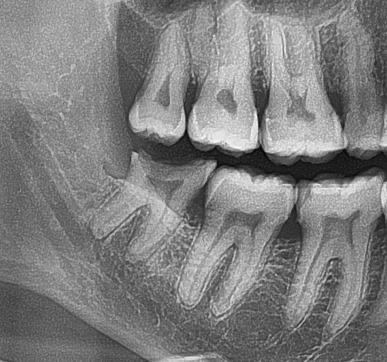 Radiographie